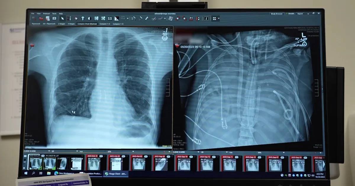 Un paciente trasplantado sobrevive 48 horas sin pulmones gracias a un sistema de oxigenación externa